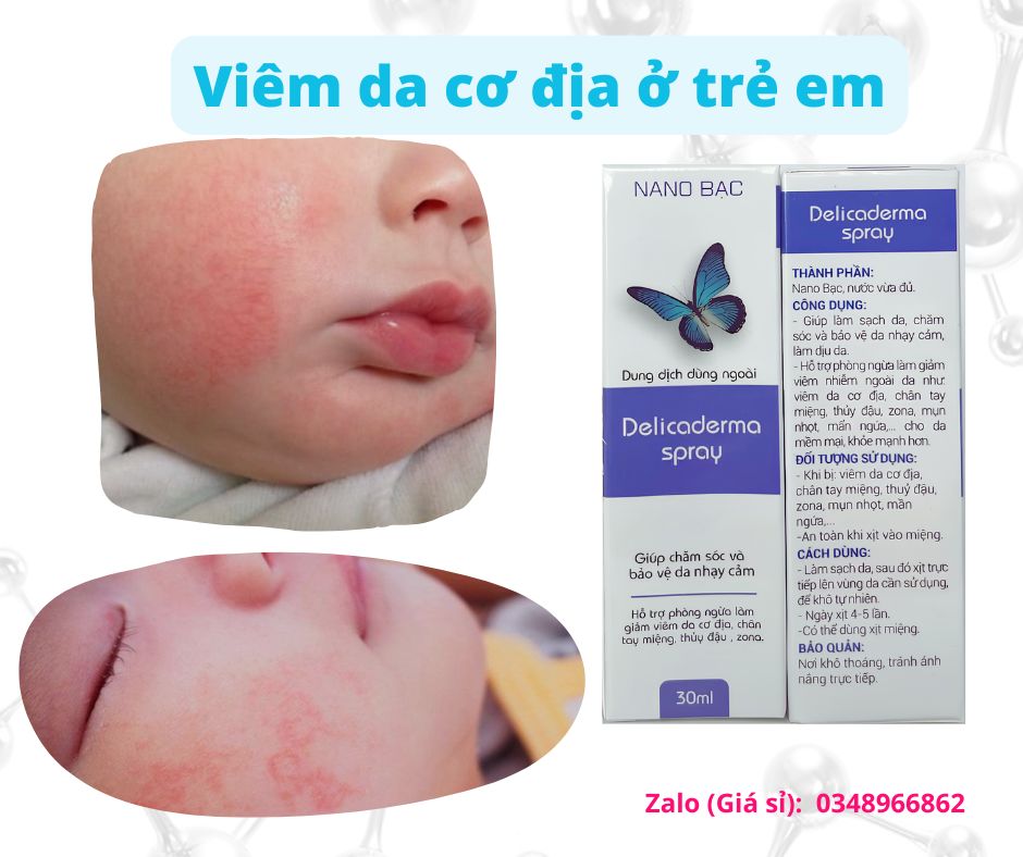 Viêm da cơ địa ở trẻ em