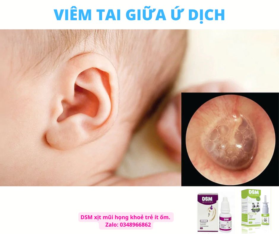 Viêm tai giữa ứ dịch điều trị và phòng tránh