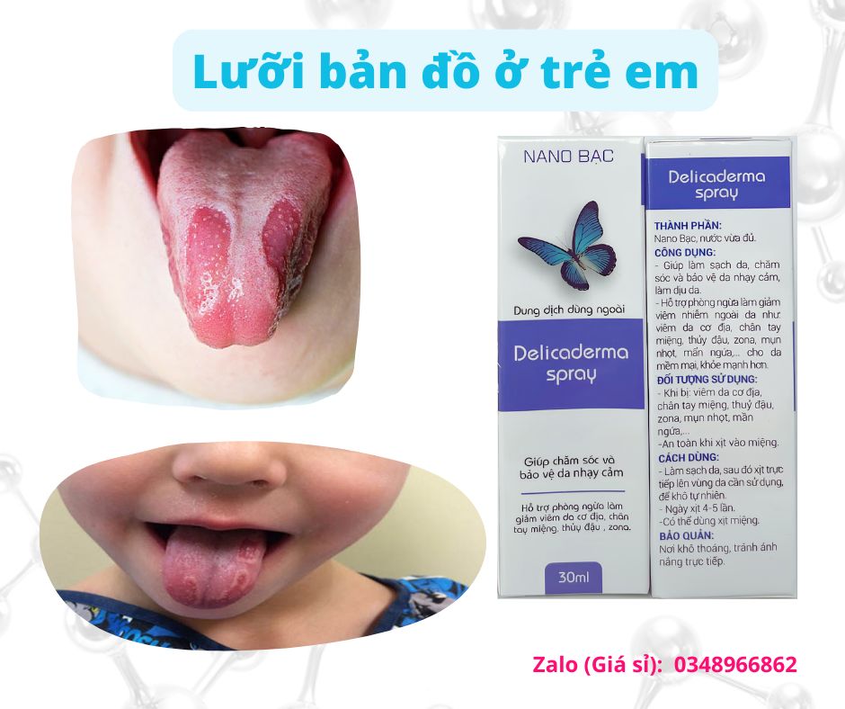 Viêm lưỡi bản đồ ở trẻ dùng xịt deli